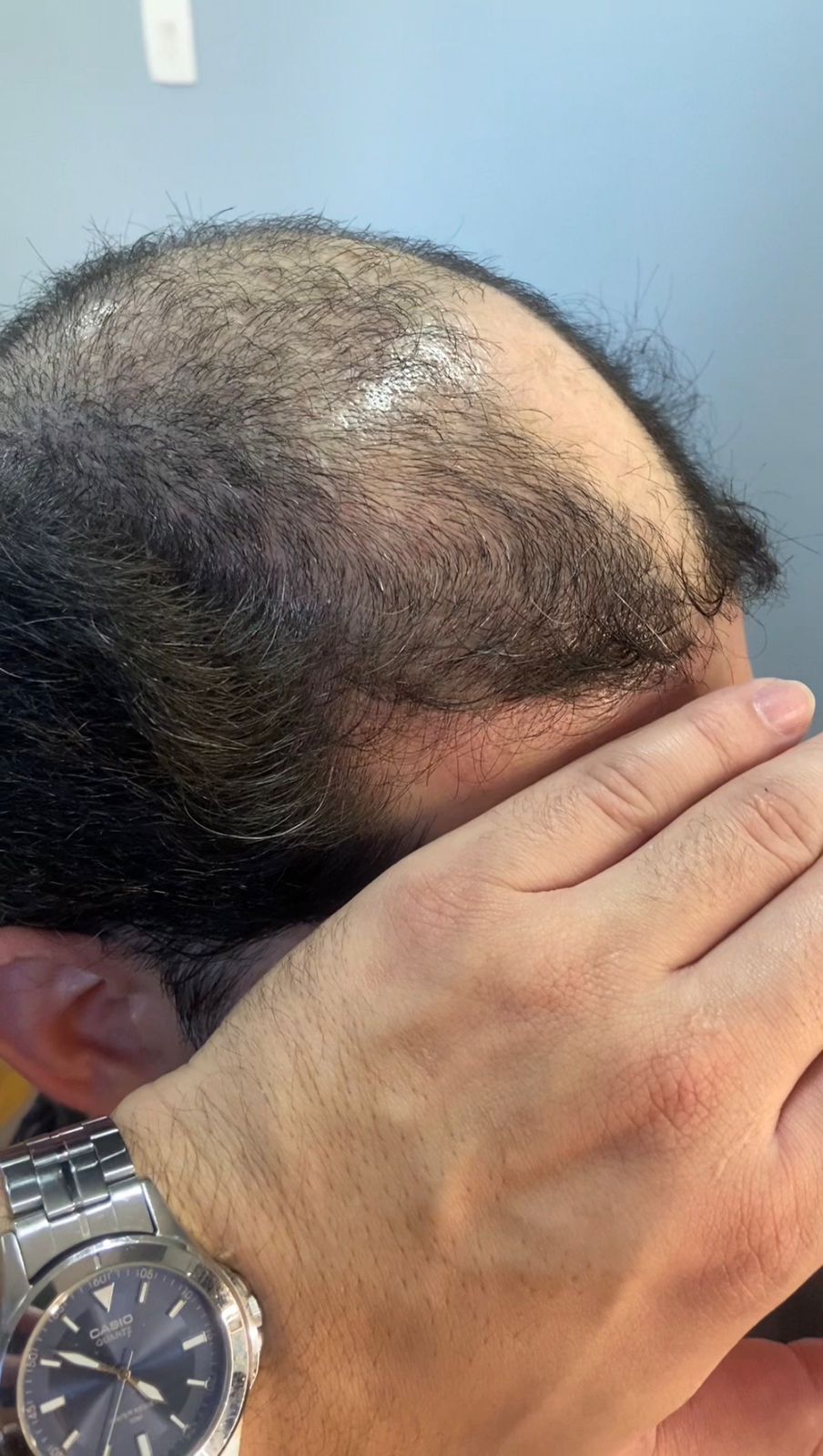 Antes da prótese capilar — Cliente real